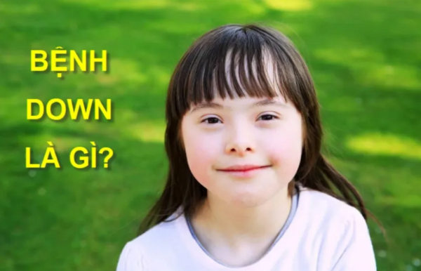 Hội chứng Down có di truyền không? 3 điều cha mẹ cần biết