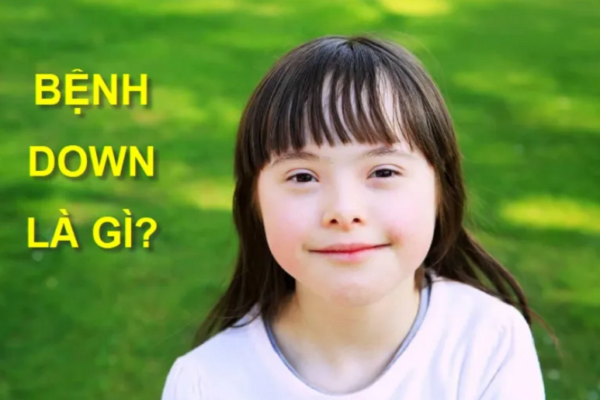 Hội chứng Down có di truyền không? 3 điều cha mẹ cần biết