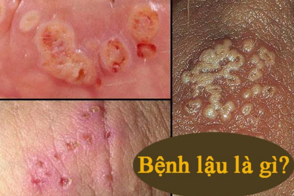 Bệnh lậu là gì? Dấu hiệu, nguyên nhân và cách phòng tránh