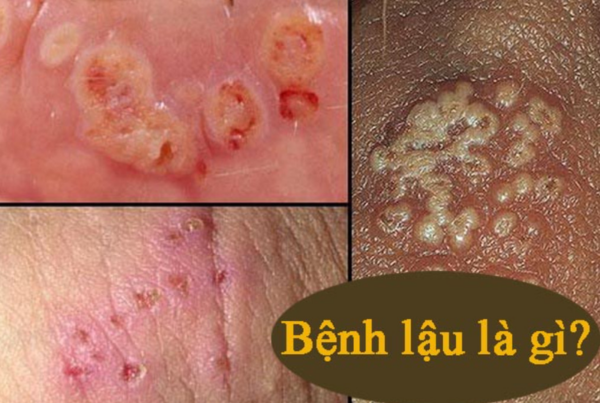 Bệnh lậu là gì? Dấu hiệu, nguyên nhân và cách phòng tránh