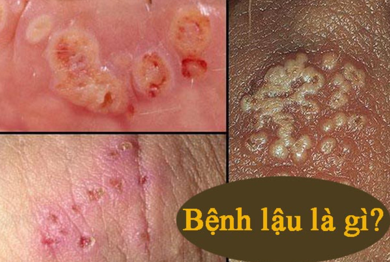 Bệnh lậu lây truyền qua đường tình dục do vi khuẩn nhóm Neisseria gonorrhoeae gây ra. 