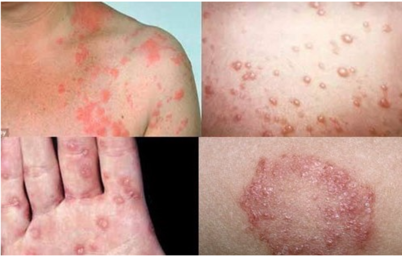 Bệnh lậu không điều trị đúng cách có thể gây biến chứng lâu dài ở cả nam và nữ. 