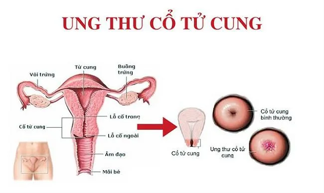 Dấu hiệu ung thư cổ tử cung như thế nào